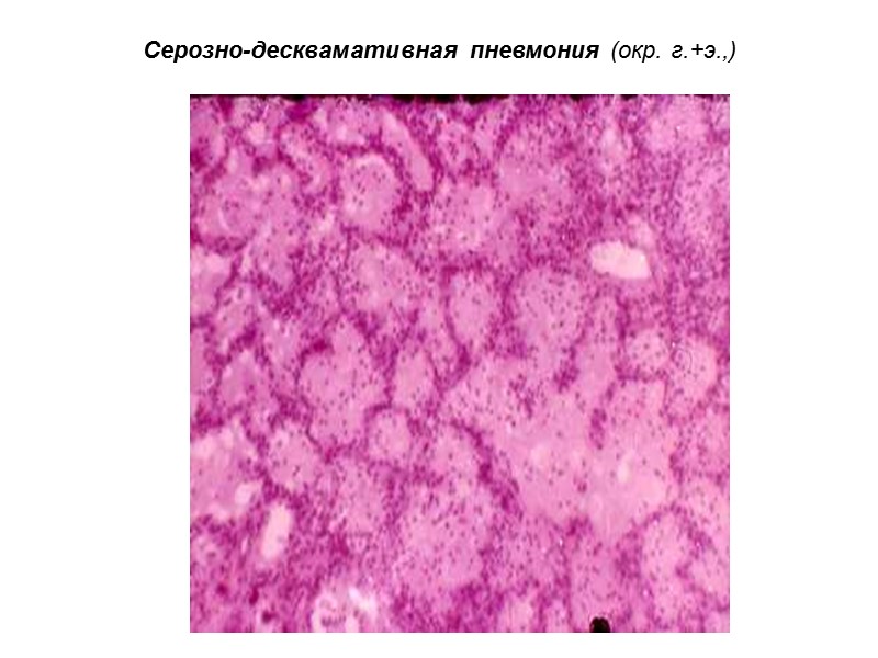 Серозно-десквамативная пневмония (окр. г.+э.,)